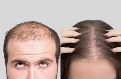 Baldness: A Guide for Women and Men