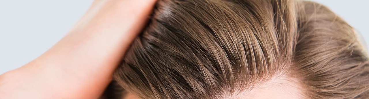 A person's hair showing signs of baldness