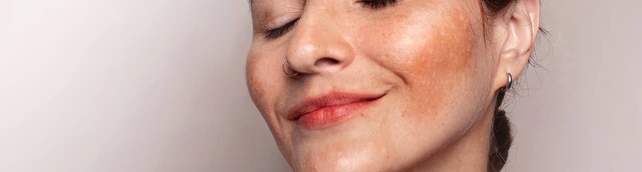 Woman with pigmentation on her cheek
