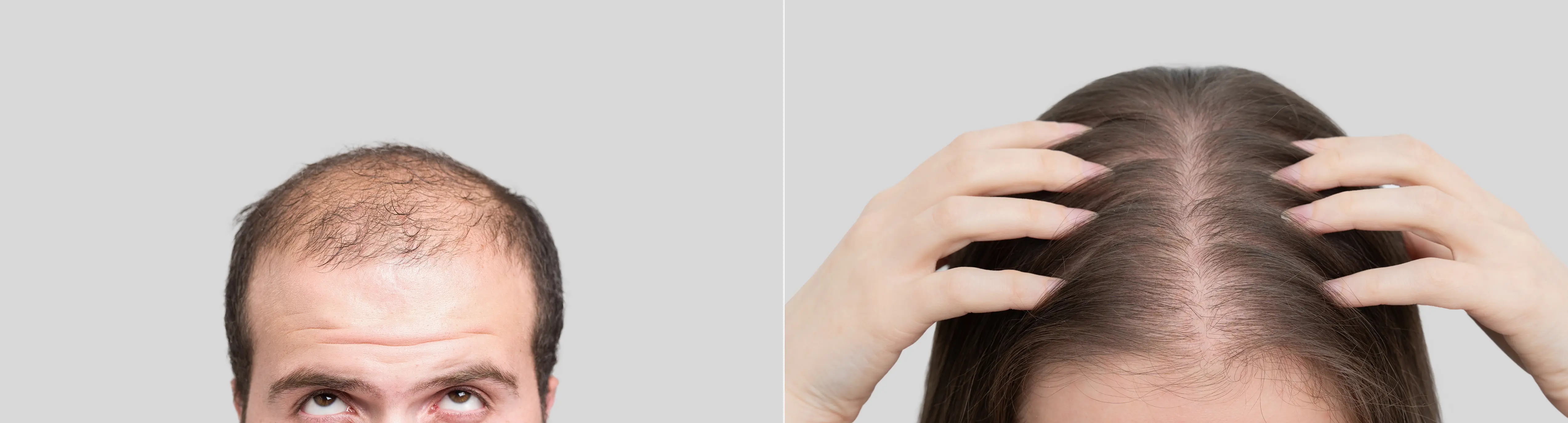Baldness: A Guide for Women and Men